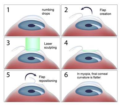 Cataract